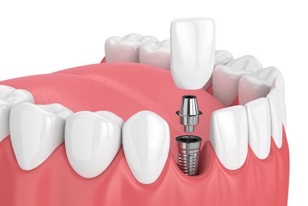 3D model of dental implants at Practice at your best in Philadelphia, Pa.